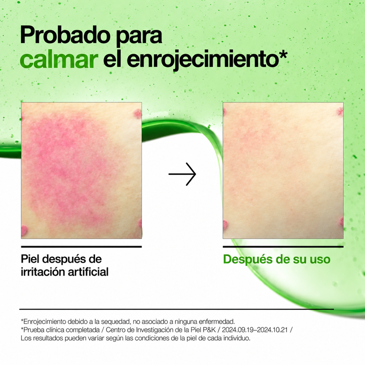 Sérum Azelaic Acid 10 Hyaluron Anua – Rojeces, brotes y piel sensible 30 ml