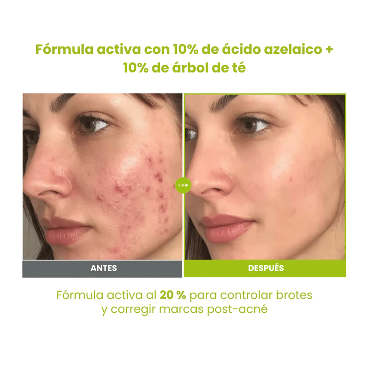 Serum de Acido Azelaico Azelaic Acid 10 Kojic Tea Tree Serum